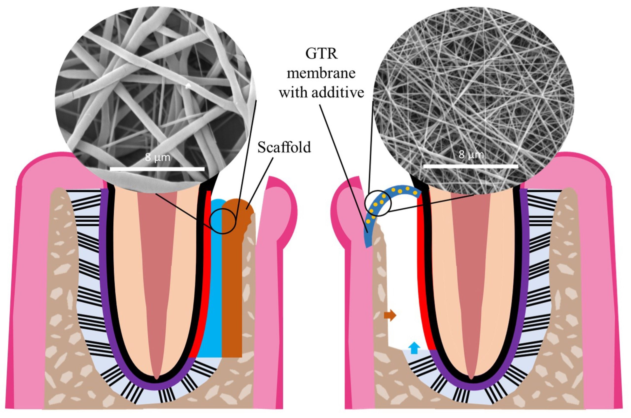 Recent advances on electrospun nanofibers for periodontal regeneration